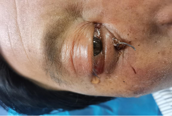 12厘米铁丝甩进男子眼眶哈医大一院眼科专家通过小切口精准定位取出