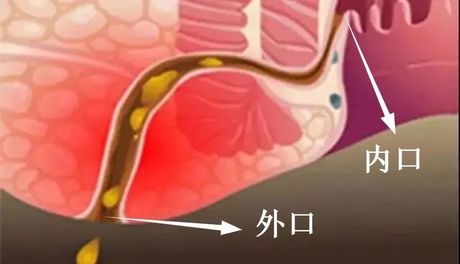 肛瘘如何分类又有哪些需要进行手术治疗