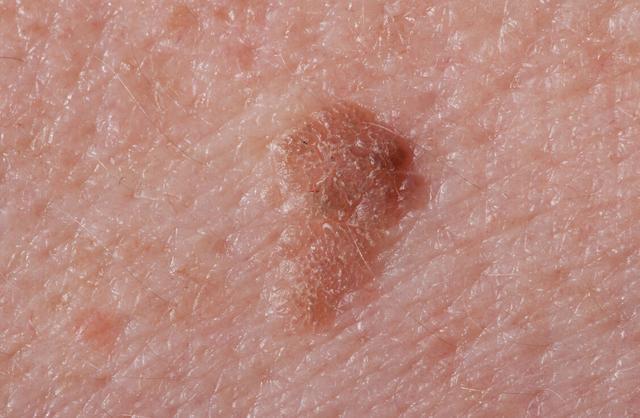 90后夫妻双双入院,大夫摇头:浴室1物经常共用,怎能不感染hpv|疣体