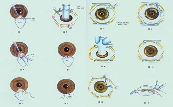 角膜移植手术成功较高,这是真的!