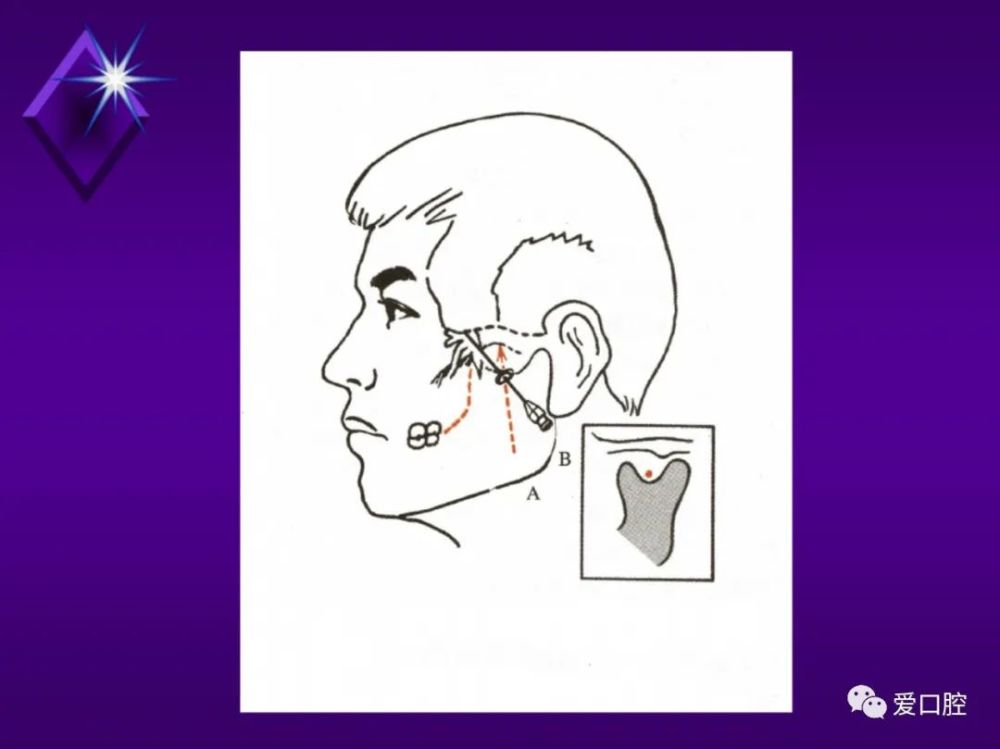颌面外科常用局部麻醉拔牙术中神经损伤的预防处理下牙槽阻滞麻醉时
