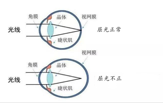 以近視眼為例,由於長時間,近距離用眼,睫狀肌就會發生痙攣,眼睛的屈光