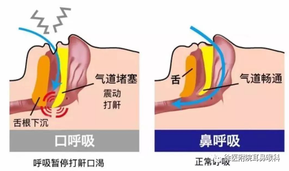 臨床症狀,其中最主要且危害最大的是兒童鼾症,可以同時合併扁桃體增大