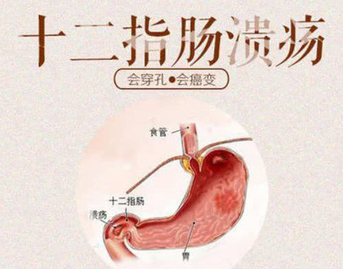 胃溃疡十二指肠溃疡是一种很严重的病吗