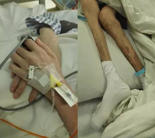 爱心红斑狼疮病发她骨瘦如柴今天好心人给她送来捐款