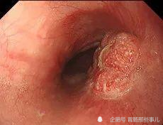 如何识别早期食管癌