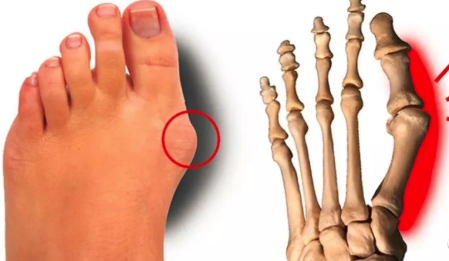 大脚骨 拇外翻 的困惑有吗 解析来了 腾讯新闻