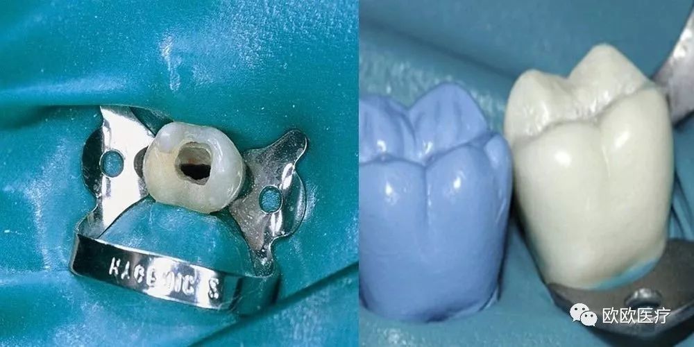 不是每一个牙医都会用橡皮障