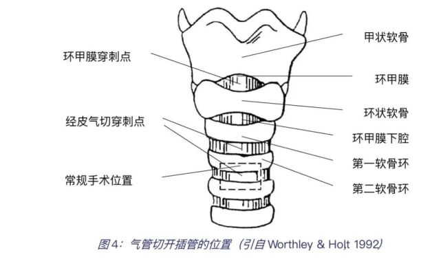 氣管切開術及護理措施