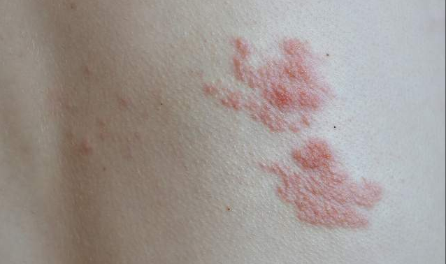 如何区别冠心病心绞痛和肋间神经痛?心血管专家有妙招,不妨了解