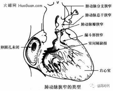 肺动脉狭窄有哪些原因