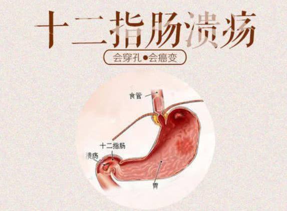 腹部|十二指肠溃疡