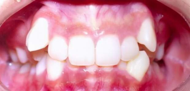 我就想去拔个虎牙,大夫却说我"虎"|虎牙|牙齿|正畸治疗|牙周