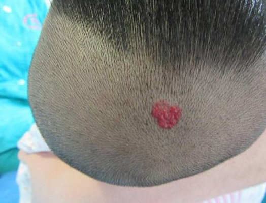 警惕!孩子身上出现的红斑,小疙瘩,可能是草莓状血管瘤