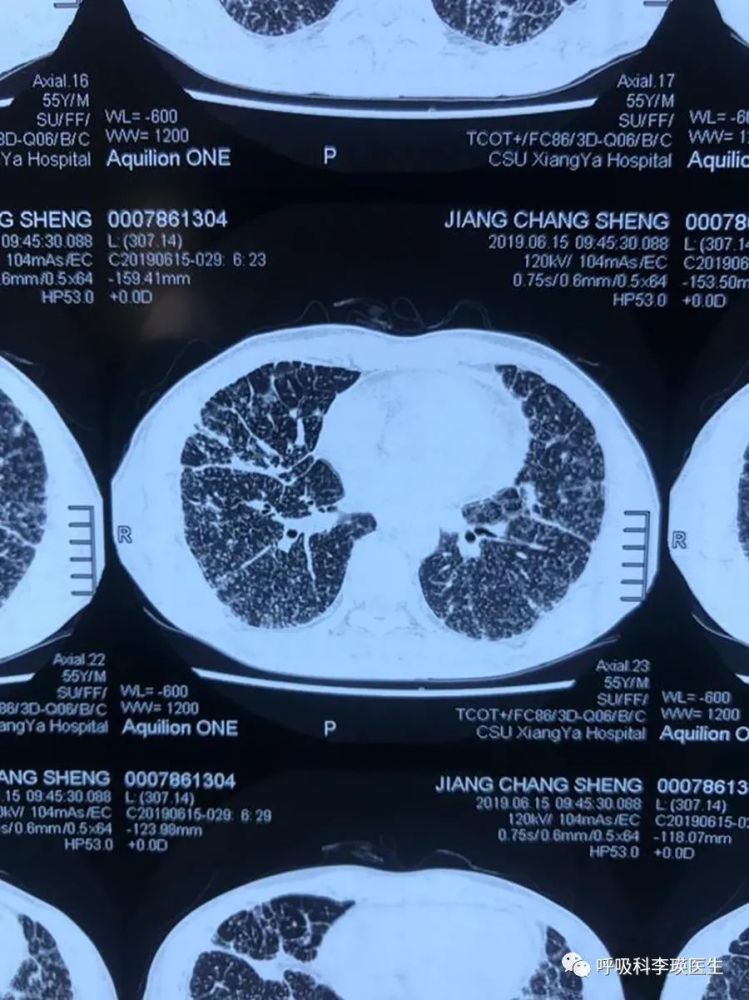 感染肺结核后多久拍ct能发现?还有什么判断途经?听医生解答_腾讯新闻