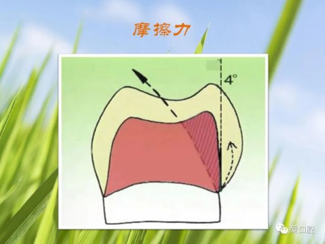 牙體預備的基本要點說明