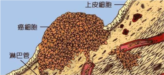既然癌细胞是正常细胞变异来的,那么癌细胞会不会有几率突变成正常的