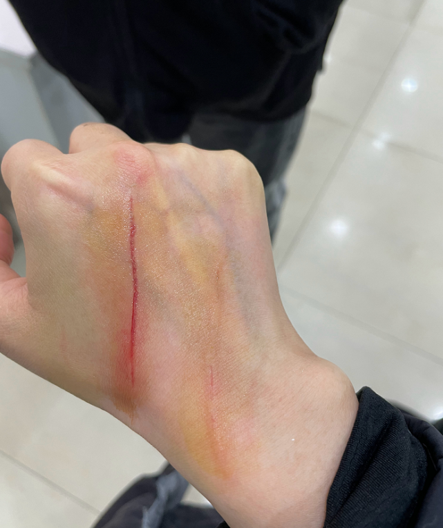 "大嫂"徐冬冬发文晒受伤照,粉丝抱怨:这"弟弟"一点也不知道怜香惜玉