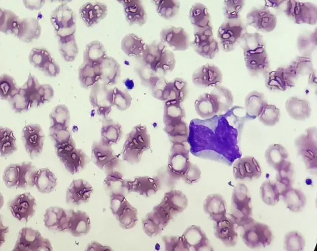 异型淋巴与幼儿急疹的一次"美丽邂逅"