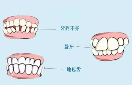 邱立東主任表示,在臨床中,很多人存在牙齒的錯頜畸形或者牙齒不整齊