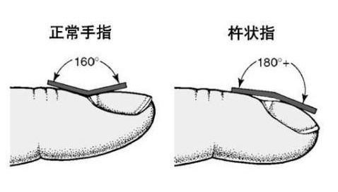 大妈手指粗圆像"鼓槌,到医院检查,医生说是肺癌!怎么回事?