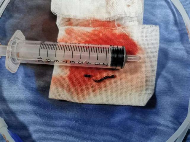 血栓取出来的样子图片
