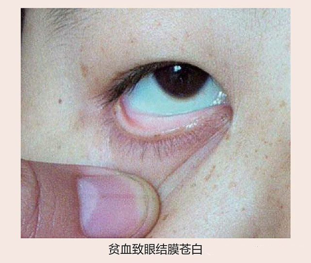 嘴唇,手和脚的甲床,当血量不足,这些地方就会变为白色,是贫血的明显