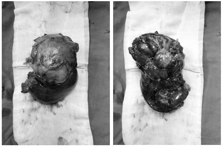 67岁广东老人拉血2个月只因肚里有个大瘤子1件事就能揪出它