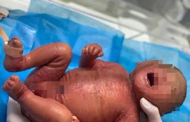 海南一宝宝出生全身为羊皮纸样是罕见的火棉胶婴儿