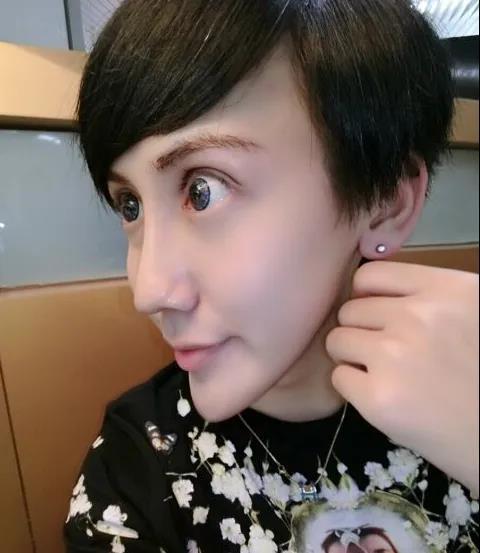 蛇精男刘梓晨美国感染新冠整容过度全脸毁容还患上抑郁症