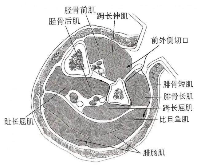 骨科精读|胫骨筋膜切开术的手术技巧,这三点非常重要!