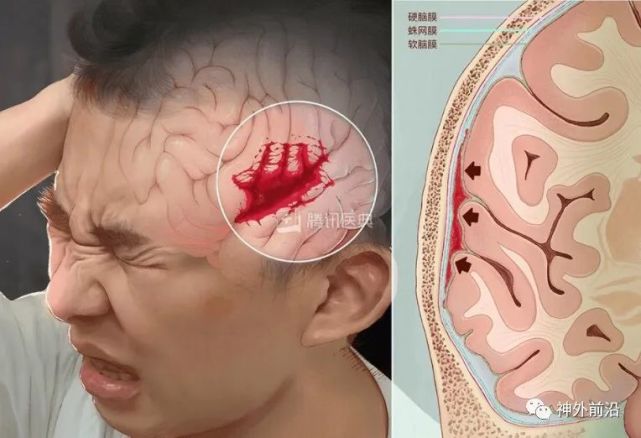 蛛網膜下腔出血病人血性腦脊液清除方式的臨床研究進展