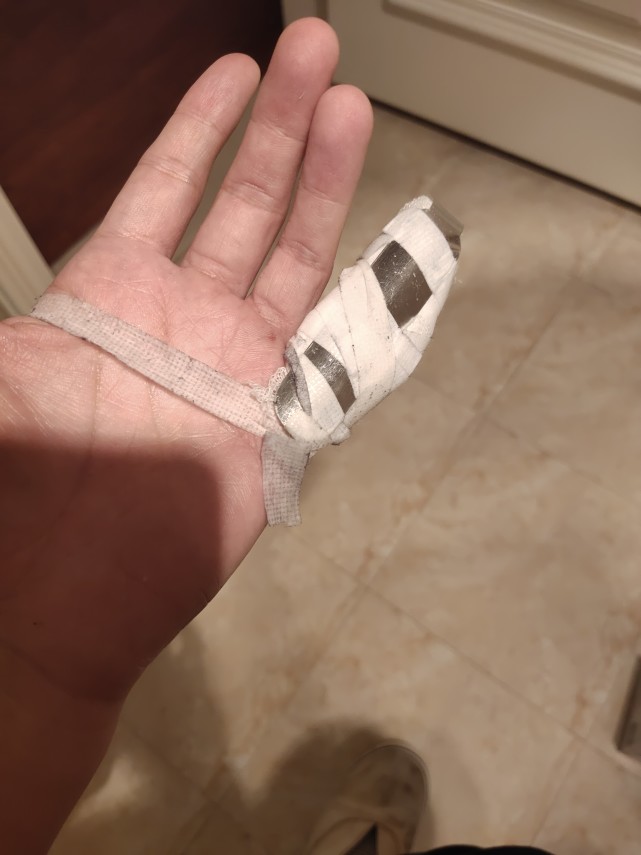 手部小指,造成小指骨折及肌腱断裂.