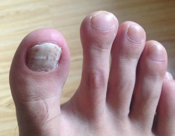 提醒 脚上出现6种表现 说明你的血糖太高了 小心糖尿病足 腾讯新闻