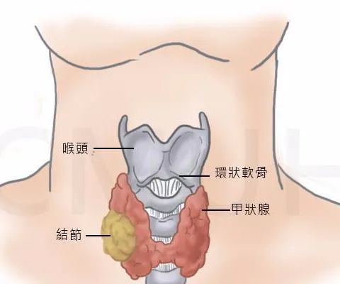 一定要注意在,你的甲状腺出现以下症状,千万不要再当成慢性咽炎_腾讯