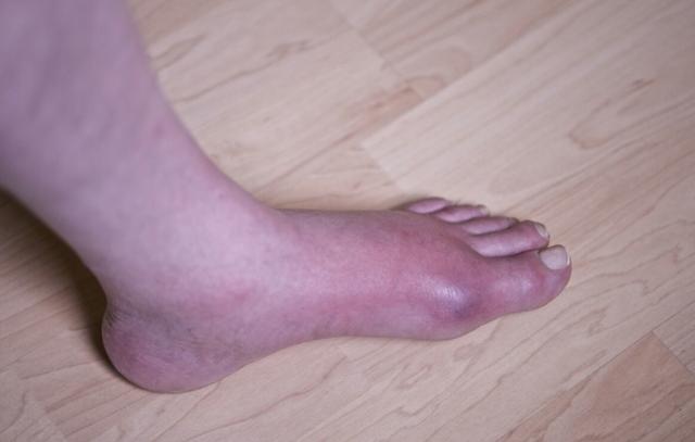 不想高尿酸引发痛风!医生提醒:做好"三多四少",尿酸悄悄降