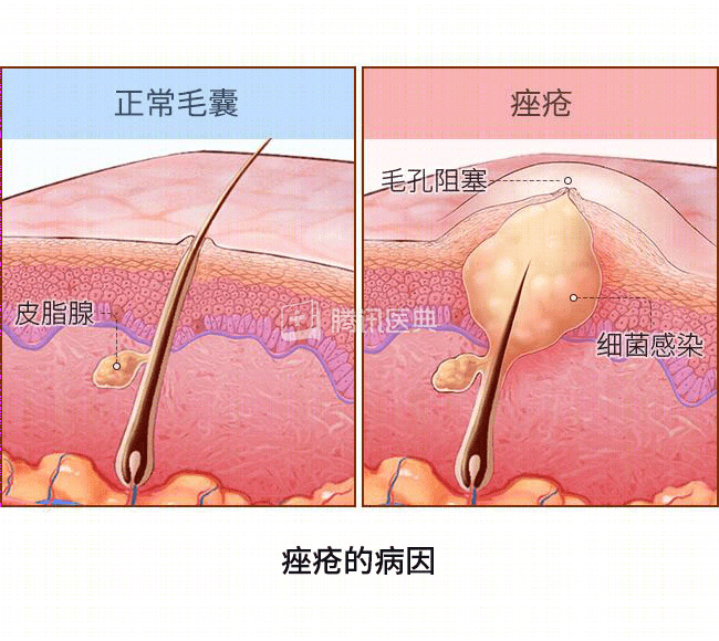 额头长了好多痘痘,搜了下,肝出问题了?