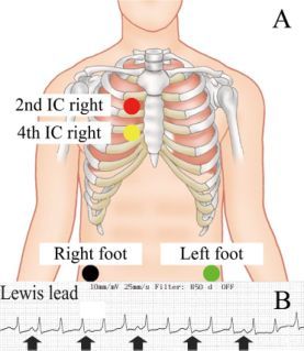 連接的導聯為ra位於胸骨柄,la位於第五類間胸骨右緣,ll位於右側季肋區
