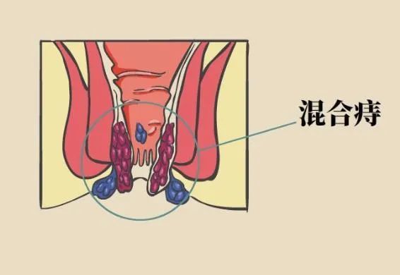 痔疮用药膏好还是药栓效果好痔疮严重了用什么药膏好得快