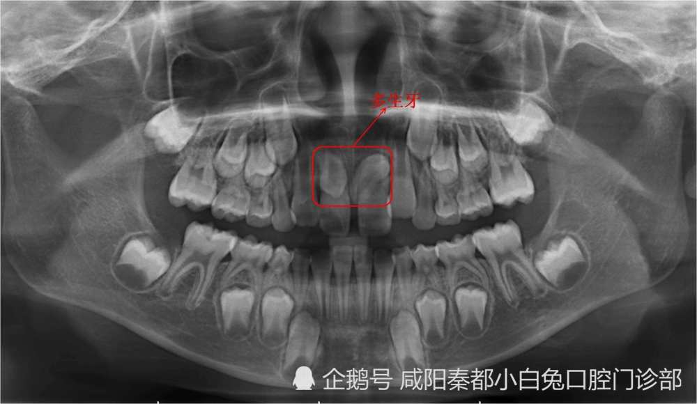 牙齿出现了疾病症状?信不信一张牙片就能发现问题