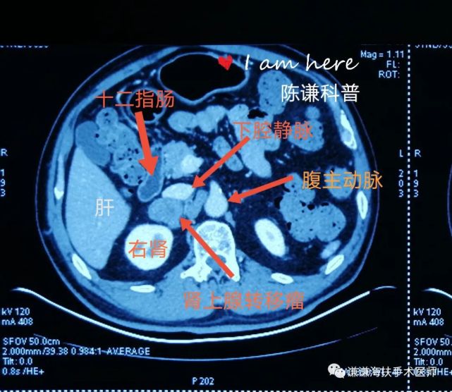 右侧肾上腺转移瘤海扶刀治疗病例分享