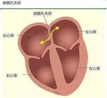 卵圆孔是胚胎时期心脏房间隔的一个生理性通道, 出生后大多数人原发隔