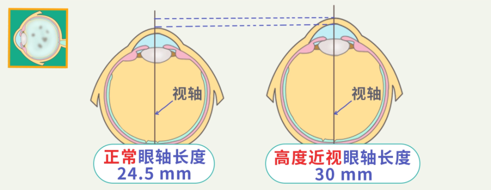 飞蚊症是怎么回事,眼睛飞蚊症是怎么回事_怎么治疗_