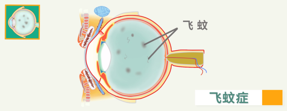 飞蚊症是怎么回事,眼睛飞蚊症是怎么回事_怎么治疗_