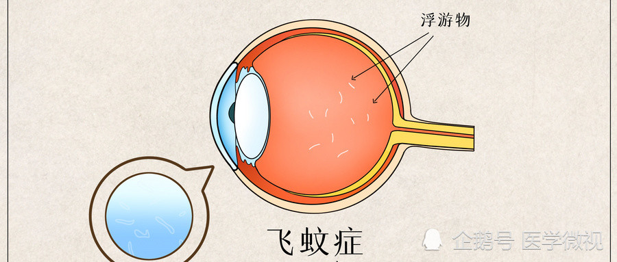 飞蚊症是怎么回事,眼睛飞蚊症是怎么回事_怎么治疗_