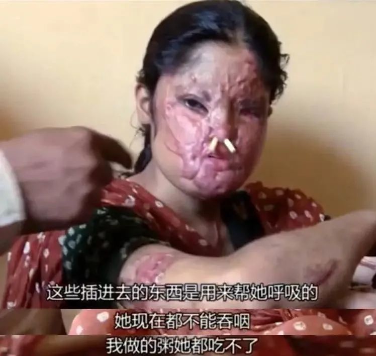 被泼硫酸毁容失明她们却登上伦敦秀场获百万点赞我们将继续美丽