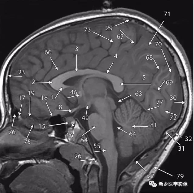 25種大腦中線處常見疾病