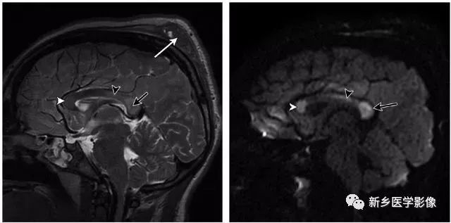 25种大脑中线处常见疾病