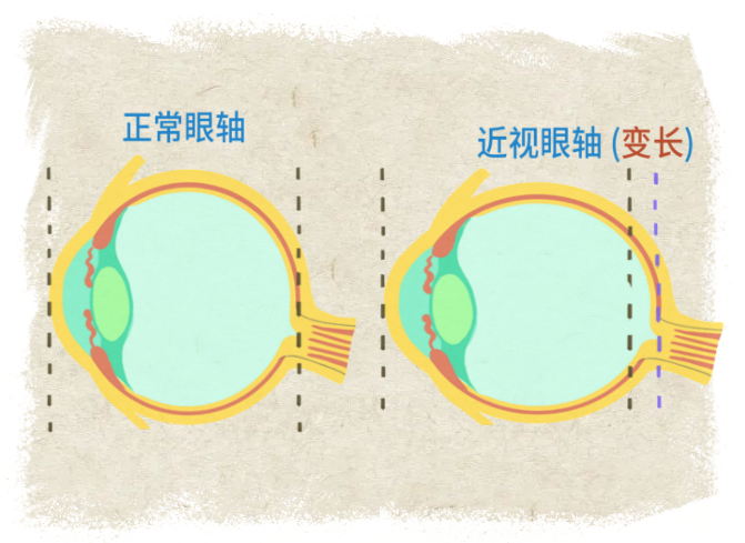 科普一文讀懂為啥眼科醫生要給孩子測眼軸