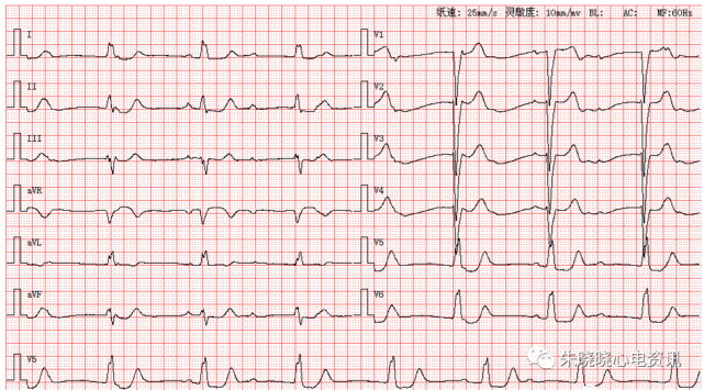 患者女,47歲,圖為其體檢覆查心電圖第1255期讀圖解析來源於中大醫院心